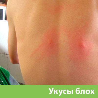 Укусы блох в Новокуйбышевске
