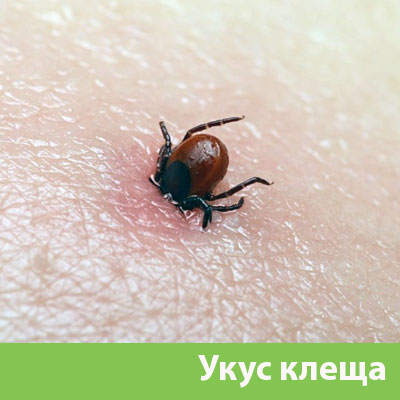 Укус клеща в Новокуйбышевске