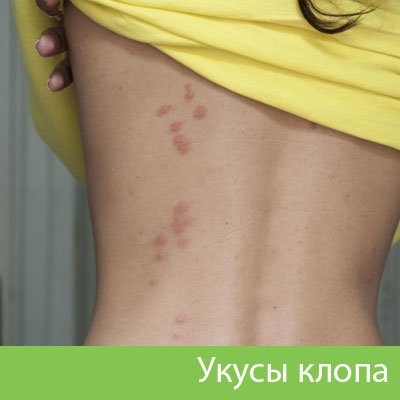 Профессиональное уничтожение клопов в Новокуйбышевске